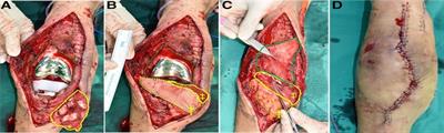 Reconstruction of complex knee wounds with a distally based gracilis flap and gastrocnemius myocutaneous flap: A case report